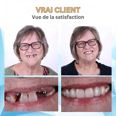 Denture Set Silicone Prothèse Dentaire For Comfortable Dental Replacement - Image 14