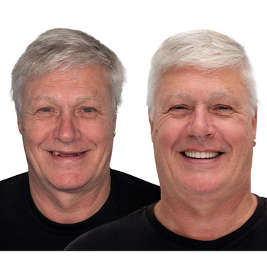 Glue Dentures Full Upper And Lower Set With Fda Registration For Comfort And Security - Image 11